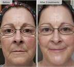 Refresh the look of dull skin with the Micro-Infusion Facial System