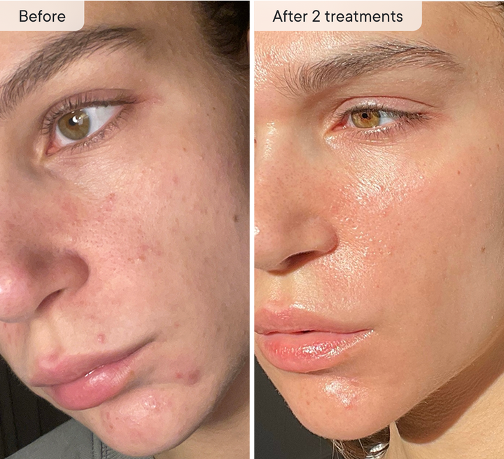 Refresh the look of dull skin with the Micro-Infusion Facial System