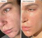 Refresh the look of dull skin with the Micro-Infusion Facial System
