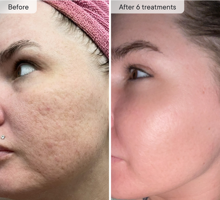 Refresh the look of dull skin with the Micro-Infusion Facial System